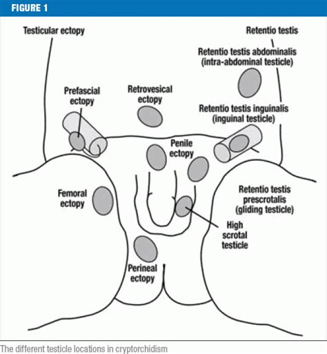 undescended testicles